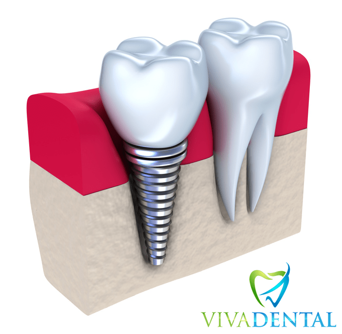 Zahnimplantate von Viva Dental